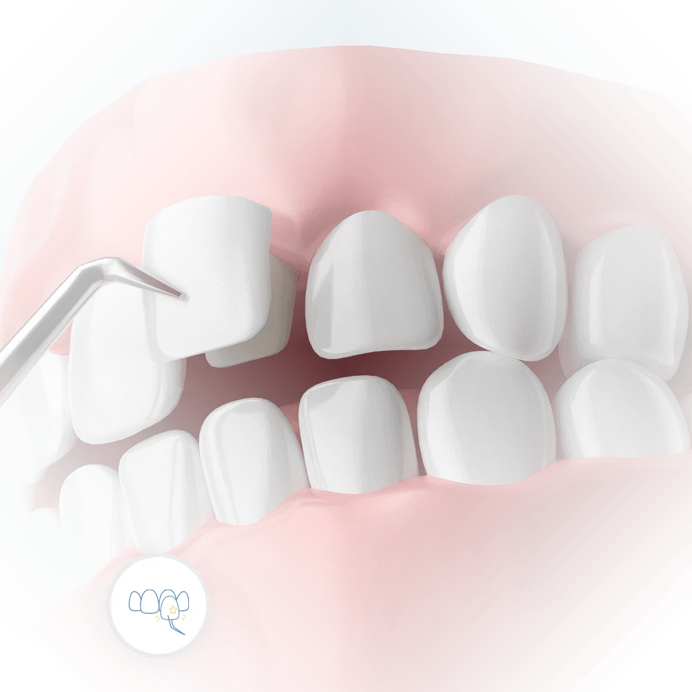 3d illustration of the dental veneers installation procedure