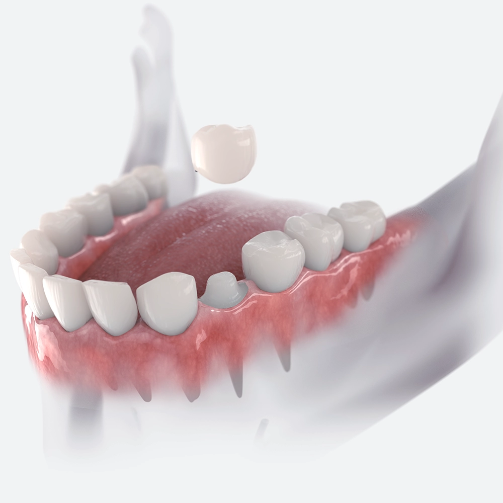 Digital display showing a detailed 3D model of dental crowns fitting over teeth, focusing on precision in dental restoration work, highlighting the crowns' snug fit over existing teeth structures.