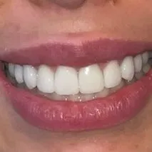 Before and after dental treatment images focused on the patient's smile. The 'Before' image reveals teeth with uneven spacing, mild discoloration, and plaque buildup. The 'After' image showcases a transformation to a radiant smile with evenly spaced, immaculately white teeth, complemented by red lipstick.