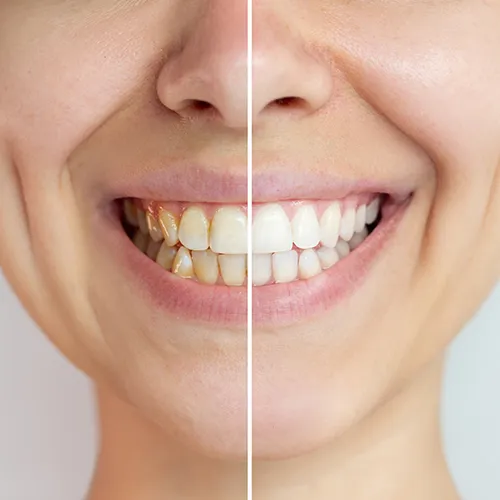 image cut into before and after of a woman's whitened smile