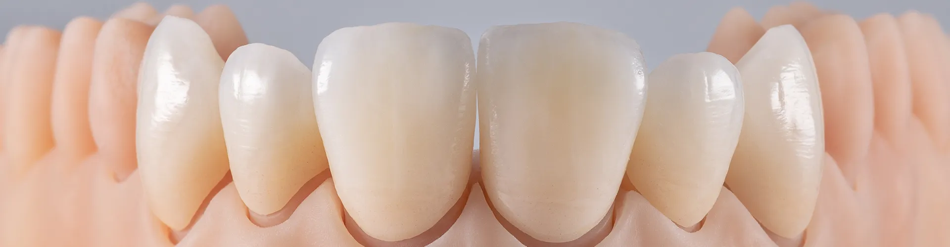 Model crown and veneers