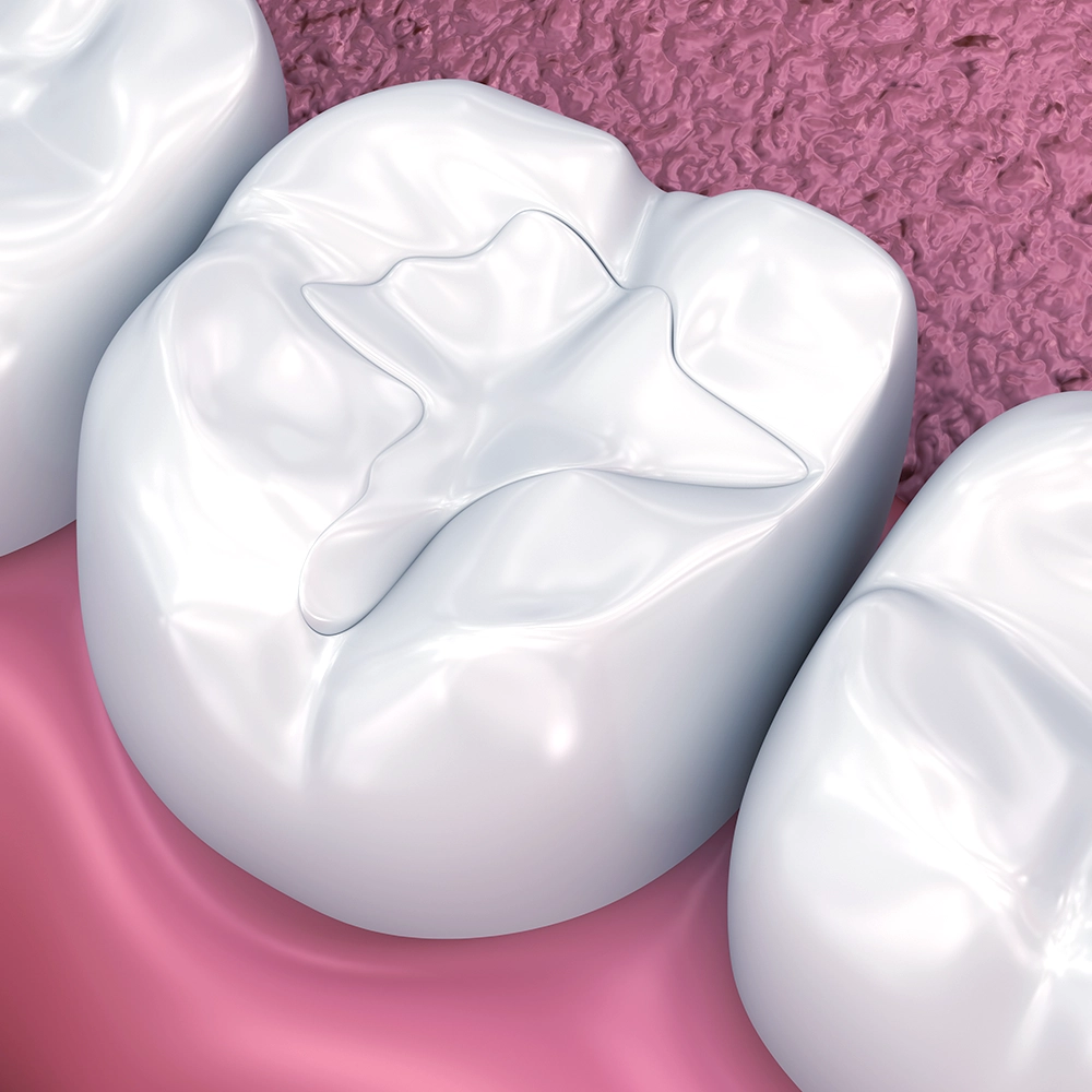 A 3D image showing a detailed view of a molar with a white, composite filling, set against a backdrop of pink gum-like texture, highlighting the precision of cavity restoration.