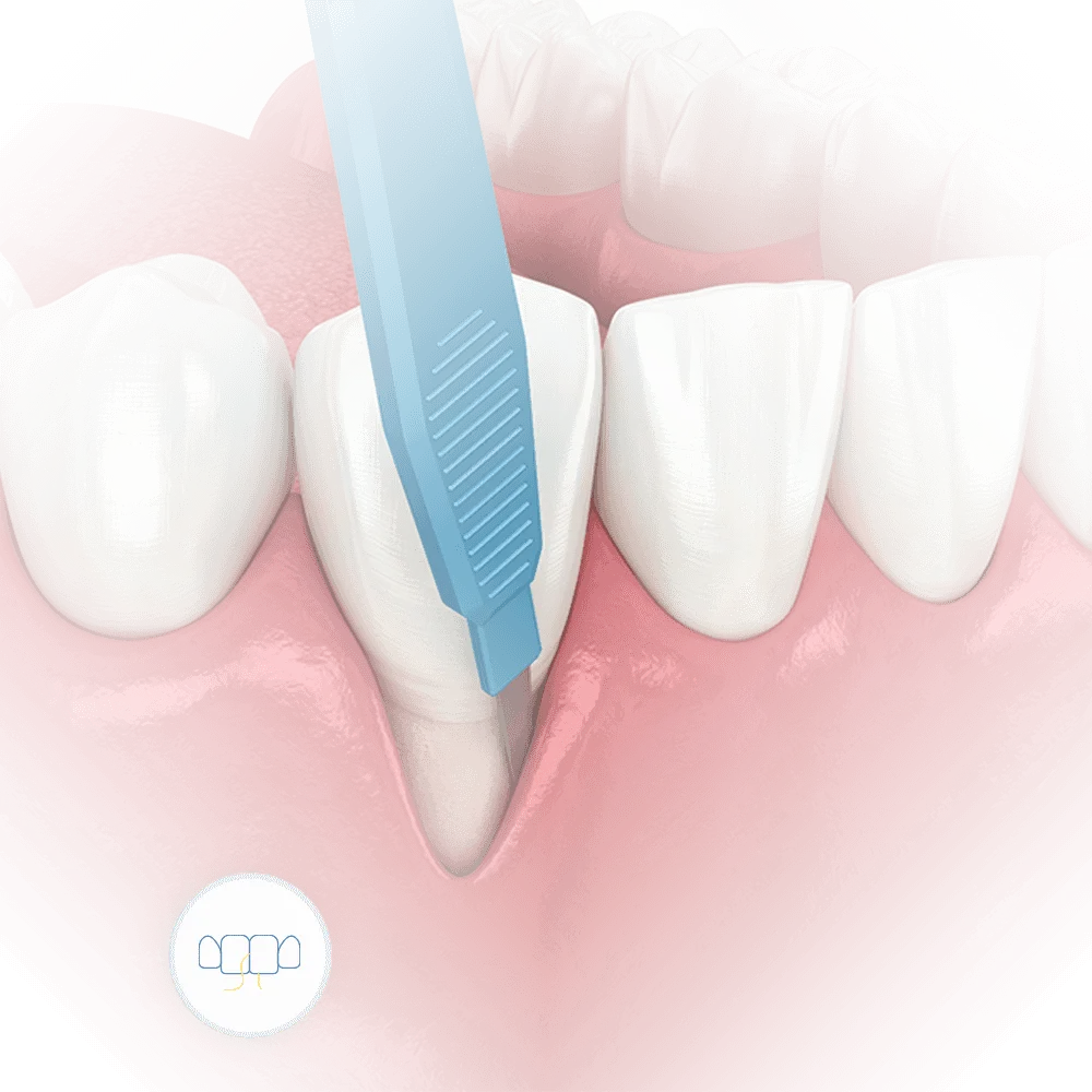 3d illustration of teeth after gum recession from severe gum disease