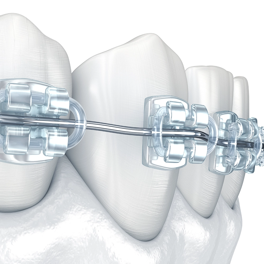 A close-up, 3D illustration of clear braces attached to teeth. The braces are modern and transparent, demonstrating the advanced orthodontic options available for aligning teeth discreetly.