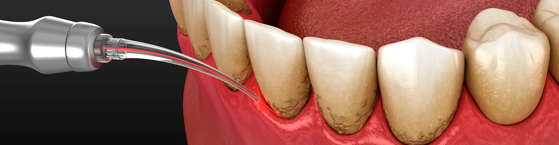 rendering of a dental laser removing buildup from teeth