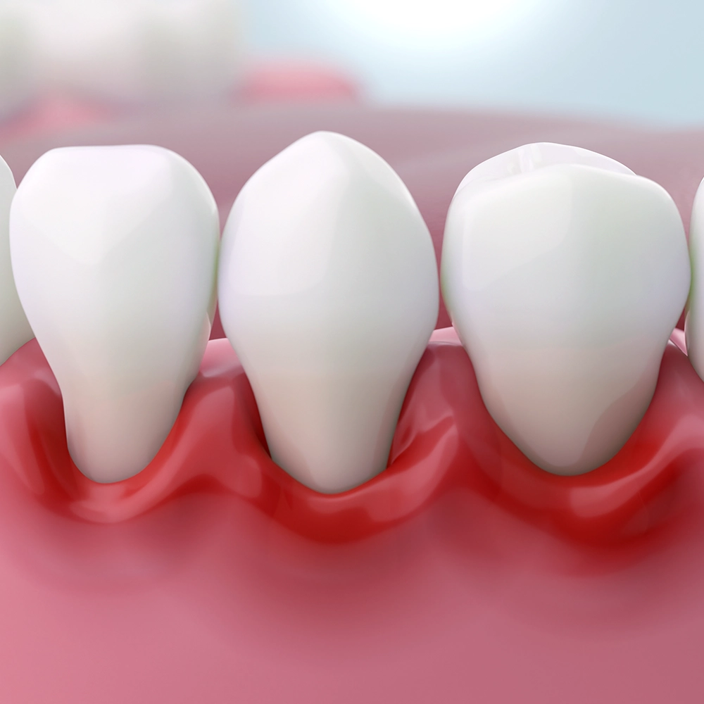 A detailed 3D rendering of a segment of gums showing healthy teeth juxtaposed against inflamed gums, illustrating the effects of gum disease and the importance of oral hygiene.