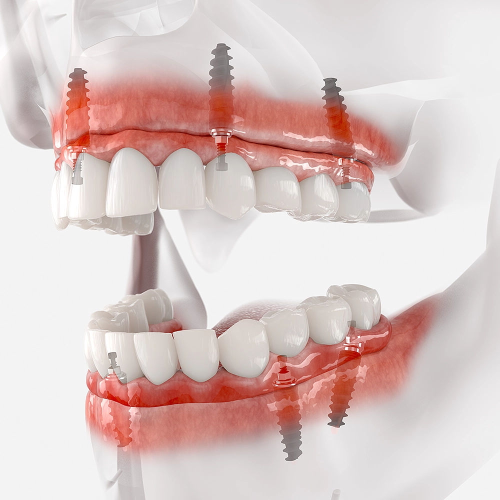 3D illustration showing a top and bottom set of implant-supported dentures in a transparent jaw model, highlighting the placement and structure of the implants within the gums.