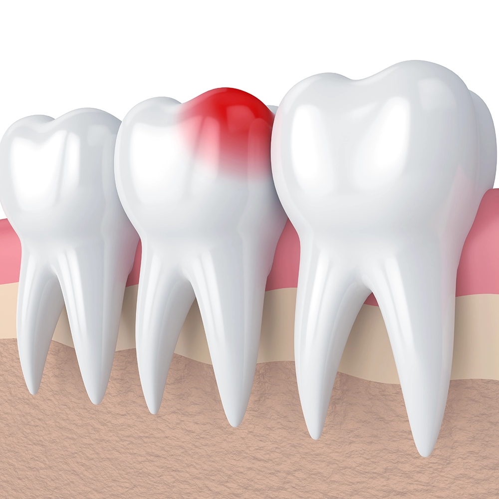 A 3D illustration of teeth in a gum line, with one tooth highlighted in red to indicate inflammation or infection, emphasizing the pain and urgency associated with dental emergencies.