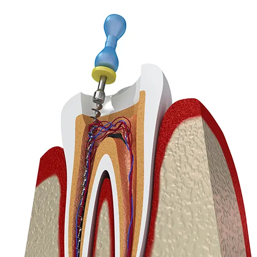 rendering of a tooth showing internal anatomy