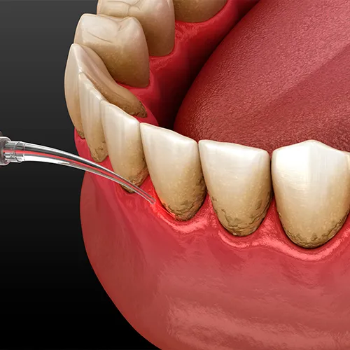 rendering of a dental laser removing buildup from teeth