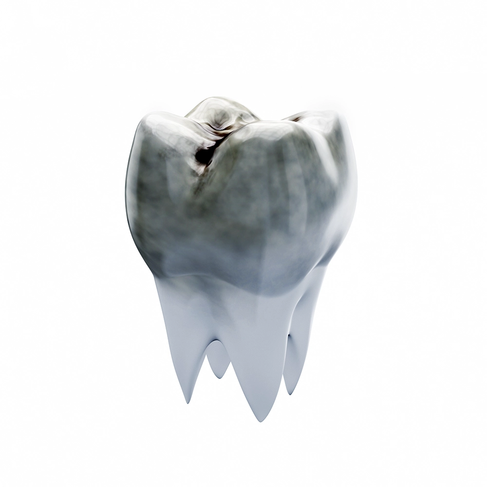 A 3D visualization of a severely decayed tooth, highlighting the damage that makes tooth extraction necessary to prevent further oral health issues.