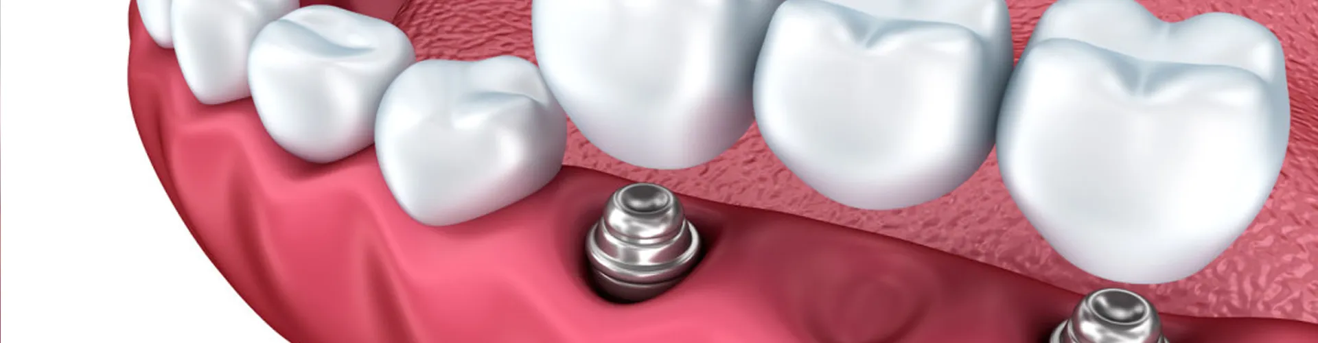 Dental implant illustration