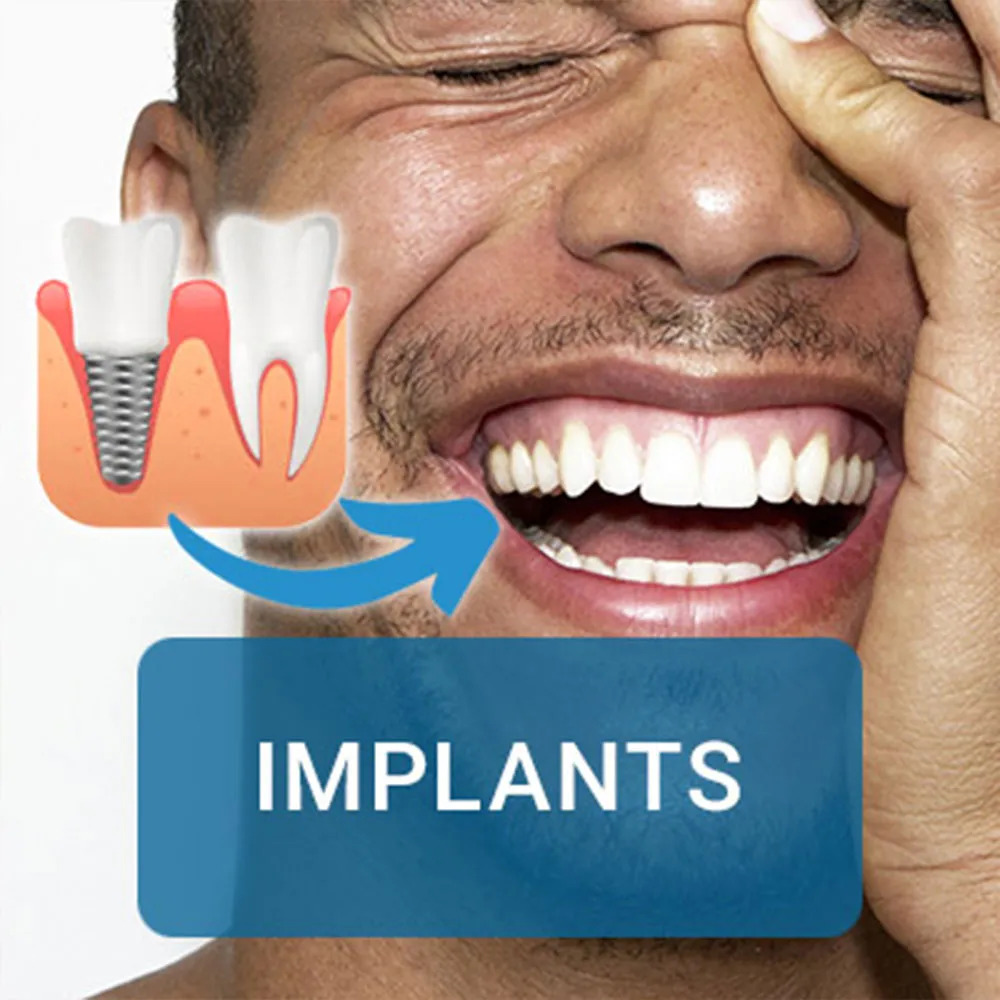 A close-up of a man smiling with a graphic illustration of a dental implant beside his teeth. The label "IMPLANTS" appears over the image.