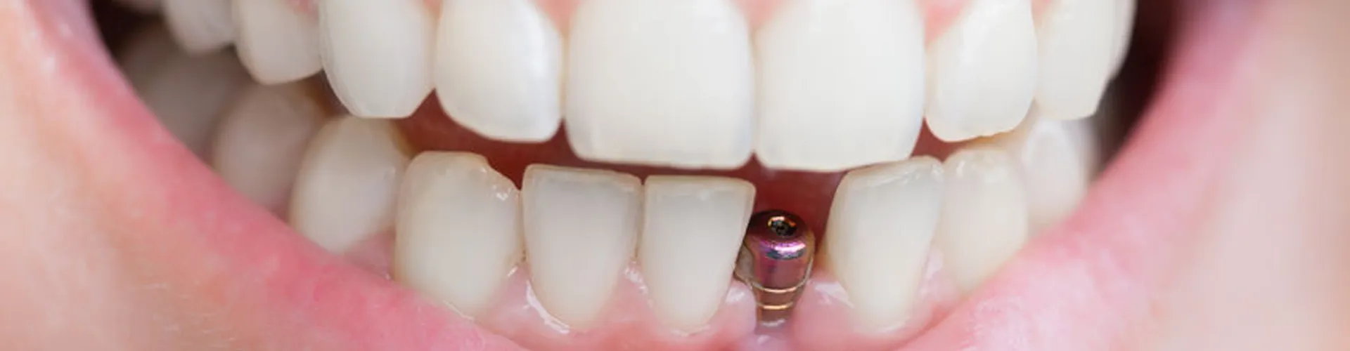 Smile with an implant