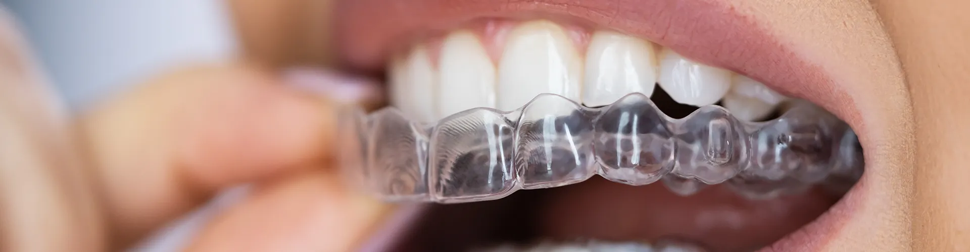 Mouth with invisalign