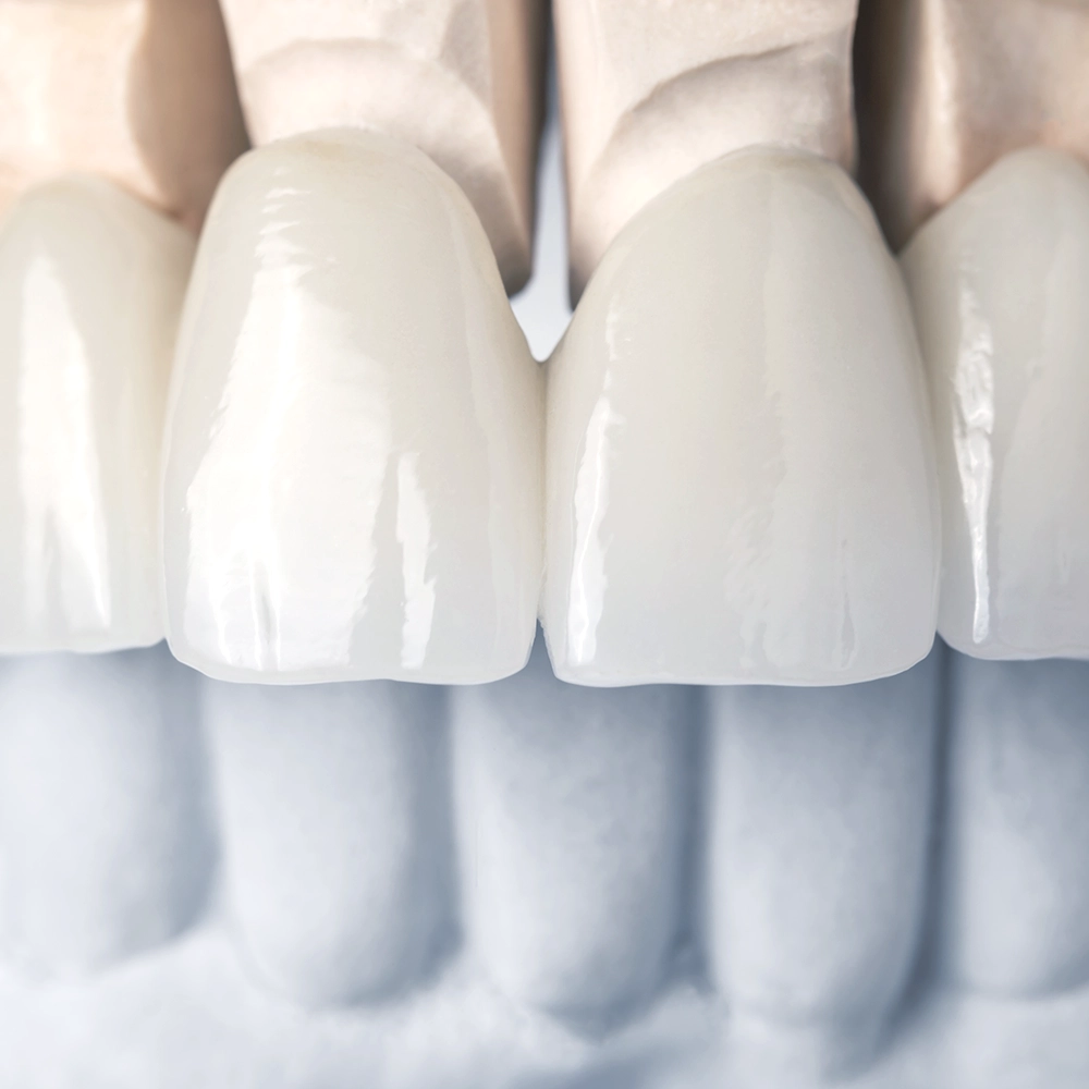 A close-up view of dental veneers being fitted onto a dental model, highlighting their precise craftsmanship.