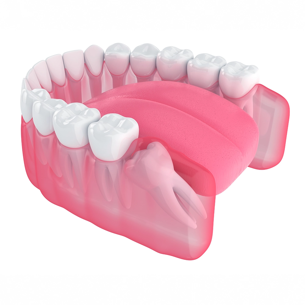 Detailed 3D rendering of a jaw section showing impacted wisdom teeth, illustrating the complexity and necessity of professional dental intervention for extraction.