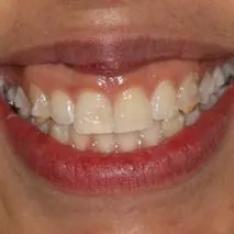 Before and after dental treatment images focused on the patient's smile. The 'Before' image reveals teeth with uneven spacing, mild discoloration, and plaque buildup. The 'After' image showcases a transformation to a radiant smile with evenly spaced, immaculately white teeth, complemented by red lipstick.