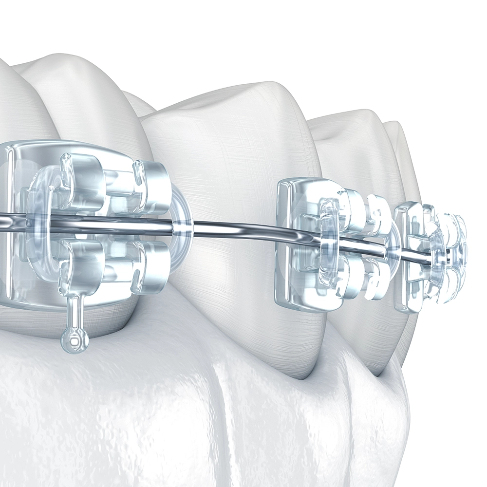 A detailed 3D illustration showing a set of teeth with clear orthodontic braces, highlighting the dental technology used for aligning and straightening children's teeth.