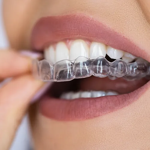 Mouth with invisalign