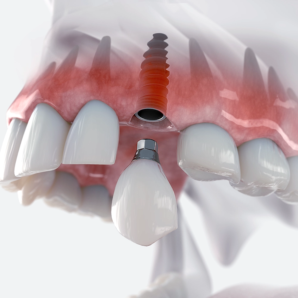 Detailed 3D illustration showing a single dental implant placed within the jawbone, demonstrating the end result of an implant surgery. 