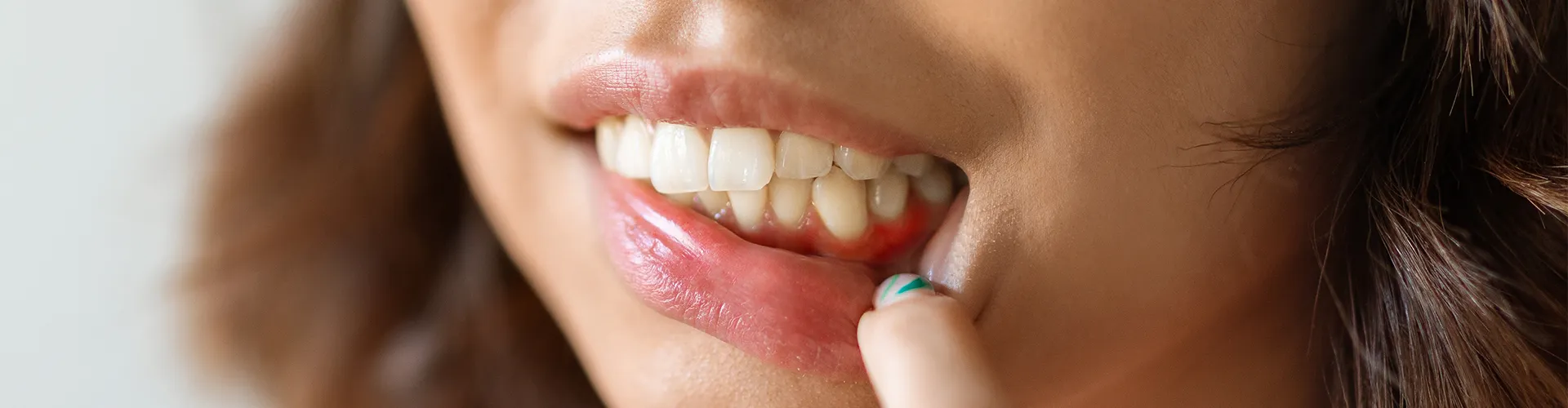 woman pulling down bottom lip to reveal inflamed gums