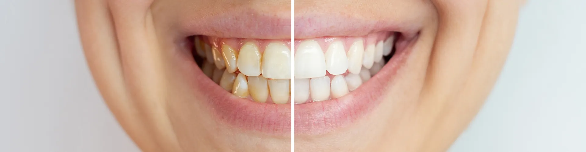 image cut into before and after of a woman's whitened smile