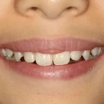 Before and after images displaying the results of dental treatment on a young patient's teeth. The 'Before' image shows teeth with noticeable plaque, slight yellowing, and misalignment. The 'After' image reveals a smile with brilliantly white, well-aligned teeth, enhancing the patient's youthful appearance.