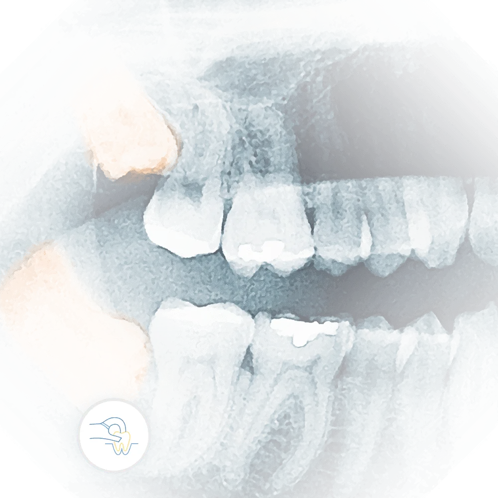 x-ray of impacted teeth requiring dental tooth extraction